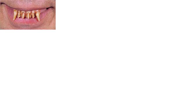 Werewolf Witch Chopper Teeth Adult Costume Accessory